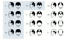 Norwood scheme of hair loss in men